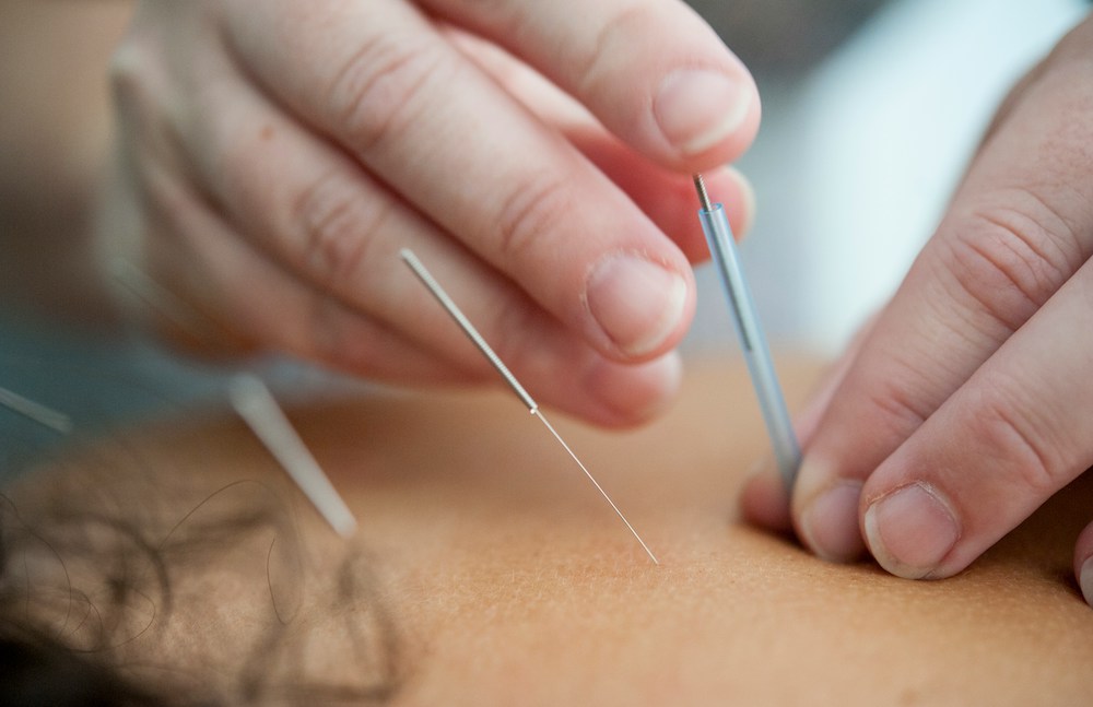 acupuncture acupressure