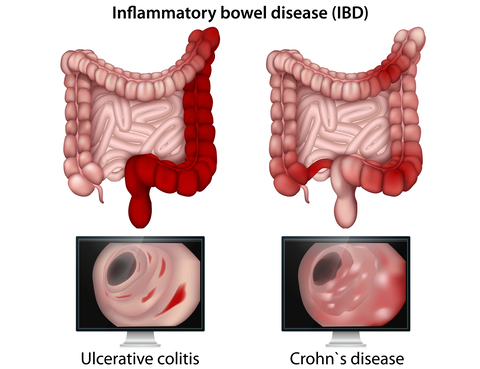 Irritable Bowel Syndrome